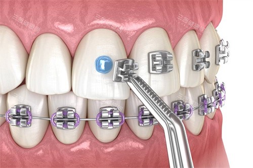 金属托槽矫正托槽粘贴 金属托槽矫正托槽粘贴