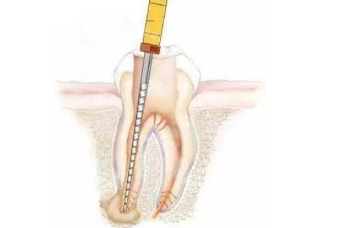 根管治疗卡通展示图 根管治疗卡通展示图