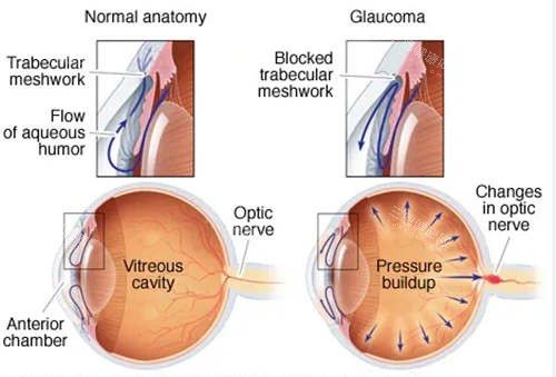 青光眼对比图 青光眼对比图