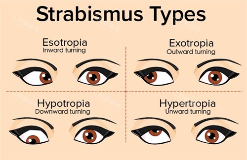 不同情况的眼睛斜视 不同情况的眼睛斜视