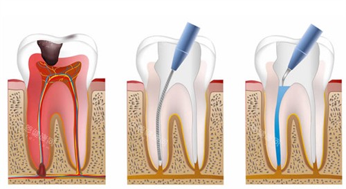 根管治疗流程图 根管治疗流程图
