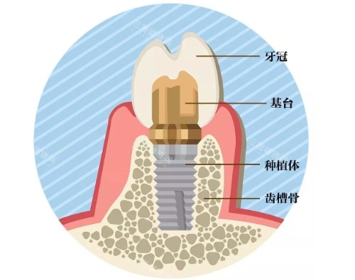 鄂尔多斯牙博士口腔医院价格表！种植牙3000元起、隐形矫正18000元起、补牙齿300元起！