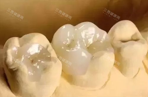 补牙模型展示图 补牙模型展示图