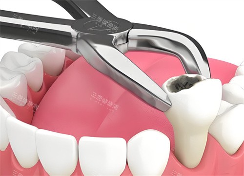 拔牙动画展示图 拔牙动画展示图