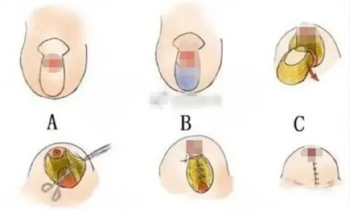 棒棒糖缩胸法(垂直双蒂法)展示 棒棒糖缩胸法(垂直双蒂法)展示