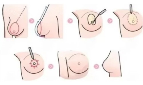 双环法缩胸展示 双环法缩胸展示