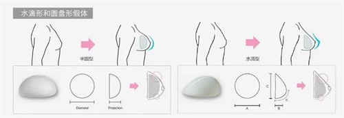 假体隆胸过程图 假体隆胸过程图