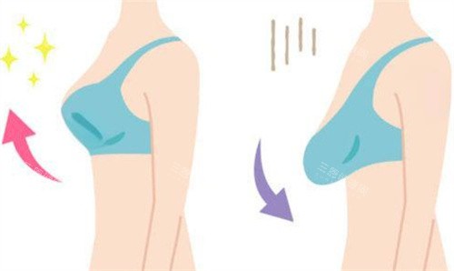胸部下垂提升 胸部下垂提升