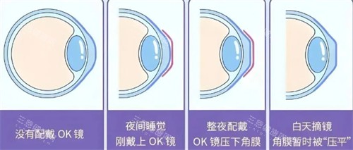 角膜塑形镜佩戴前后对比图