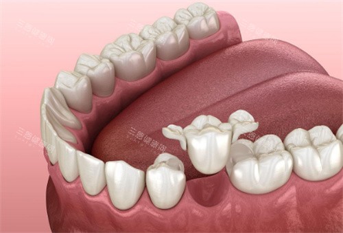 牙齿修复动画展示图 牙齿修复动画展示图