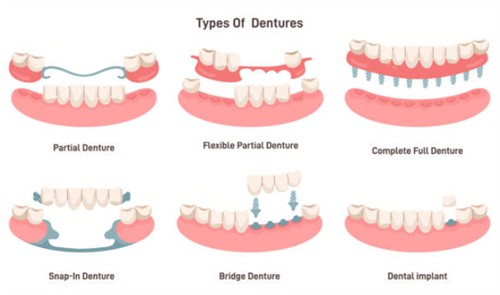 牙齿缺失示意图 牙齿缺失示意图