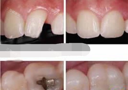 补牙过程