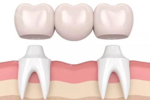镶牙卡通展示图