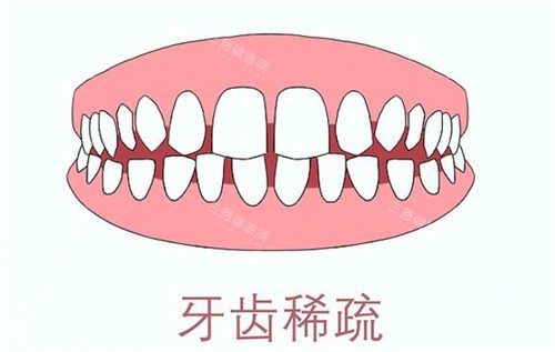 牙齿稀疏卡通示意图