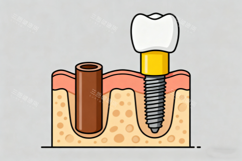 单颗种植牙卡通图展示