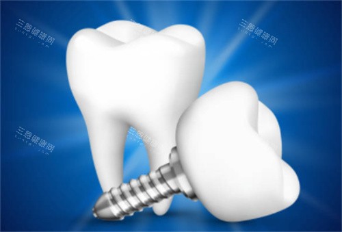 2颗种植牙模型图 2颗种植牙模型图