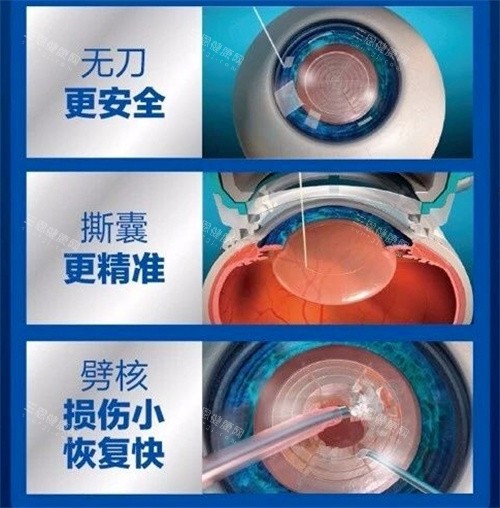 飞秒激光治疗白内障手术图