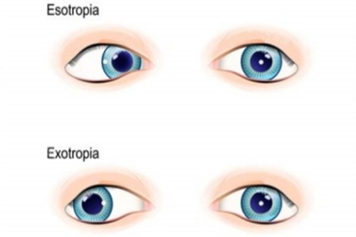 单眼斜视 单眼斜视