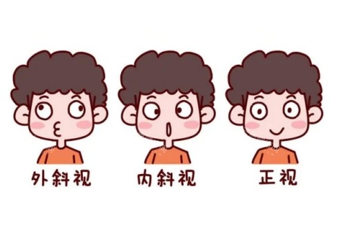眼睛内斜视外斜视正常眼睛对比图 眼睛内斜视外斜视正常眼睛对比图