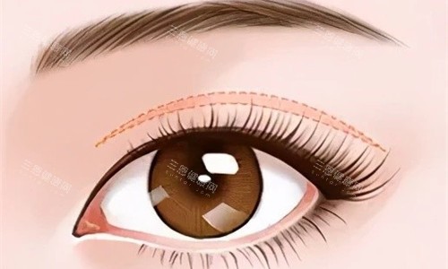 呼和浩特割双眼皮哪里好？韩赋|京美|亚太|张高贵|华医是呼市正规技术审美好的眼整形机构