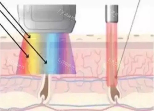 2025-2026太原疤痕修复价格明细更新！痘坑3000起+增生疤5000起+内线性疤2000起