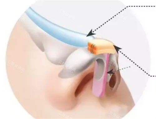 隆鼻假体植入鼻背动画展示图 隆鼻假体植入鼻背动画展示图