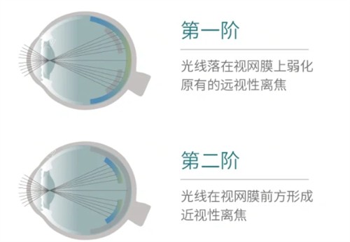 思问子夏离焦眼镜矫正过程 思问子夏离焦眼镜矫正过程