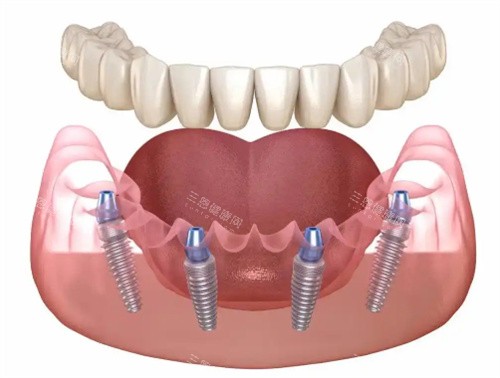 种植牙展示卡通图