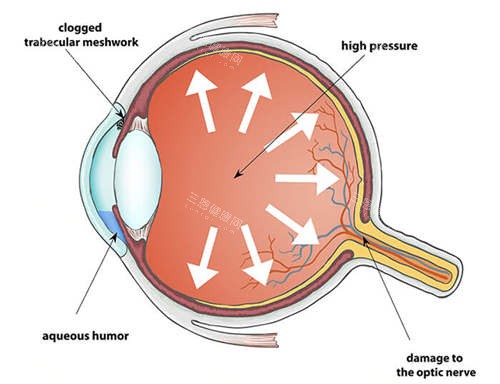 青光眼6 青光眼6