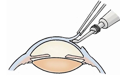 北京同仁医院眼科预约电话010，24小时在线咨询，医师号源紧张速抢！