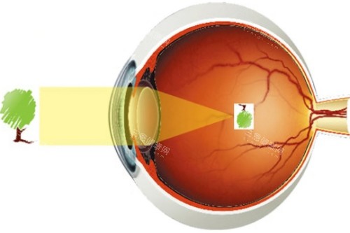 近视视物图 近视视物图