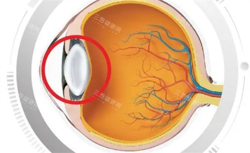 白内障的眼球 白内障的眼球
