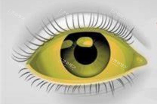 眼睛发黄示意图 眼睛发黄示意图