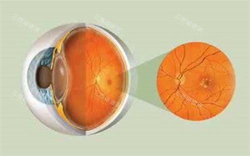 眼底病示意图 眼底病示意图