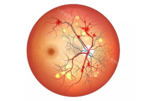 视网膜色素变性概念图 视网膜色素变性概念图