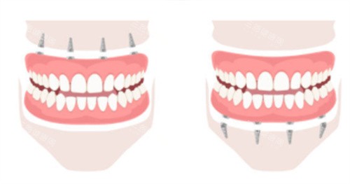 上半口种植牙和下半口种植牙
