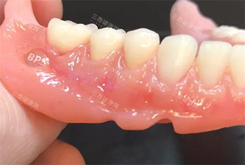 BPS吸附性义齿成品