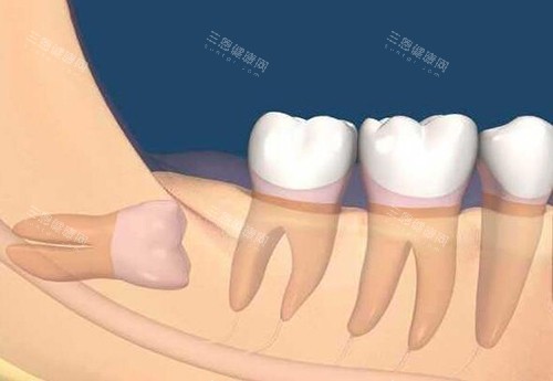 牙齿阻生智齿卡通图
