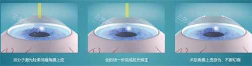 常州近视手术价格大揭秘!全飞秒15000元起,半飞秒10000元起值不值?