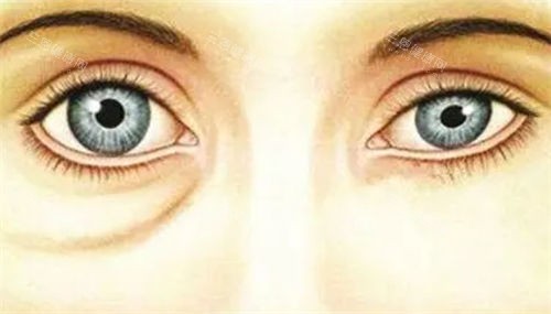 假性眼袋对比展示图