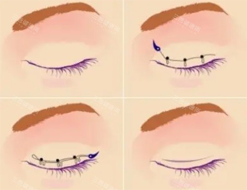 北京王博谦医生做双眼皮到底怎么样?揭秘他的拉链缝合技术和修复病例