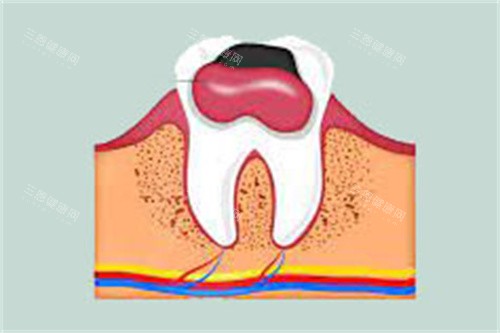 牙齿内息肉 牙齿内息肉