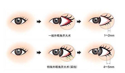 开外眼角手术过程