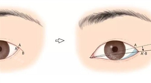 小眼外眼角开大前后对比图.jpg