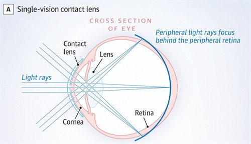 离焦镜成像原理 离焦镜成像原理