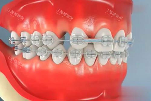 牙齿矫正模型漫画