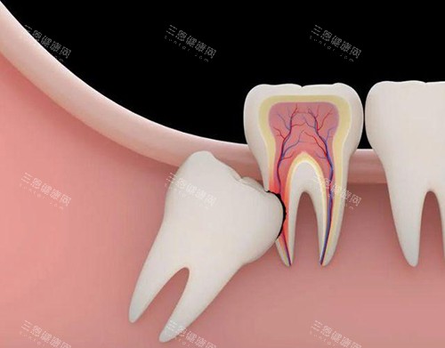 智齿漫画示意图 智齿漫画示意图