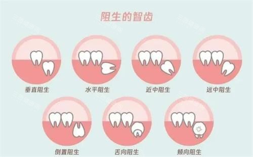 阻生智齿的示意图 阻生智齿的示意图