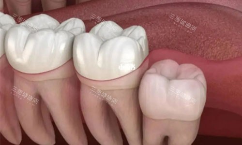 正位萌生智齿 正位萌生智齿