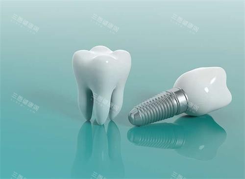 种植牙模具示意图